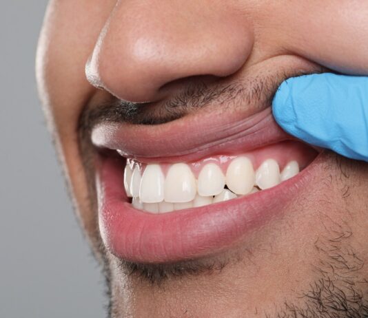 What Causes Receding Gums? receding gums