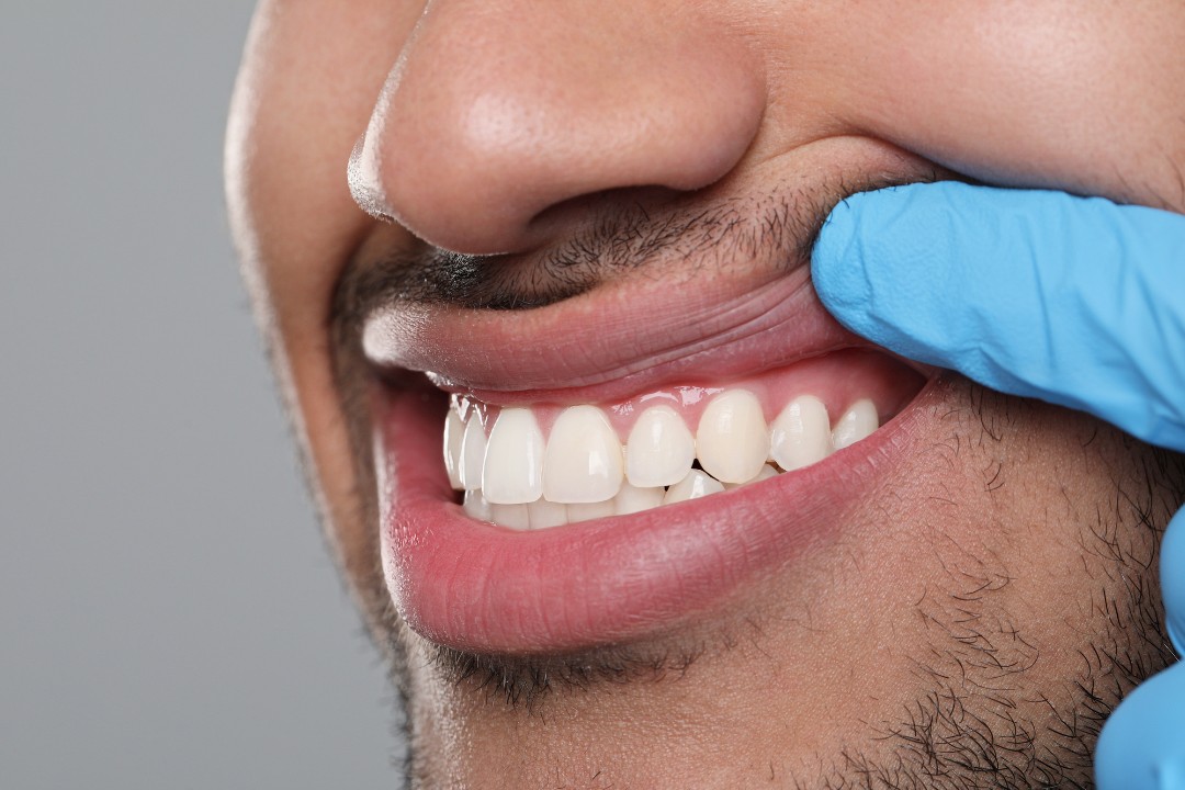 What Causes Receding Gums?